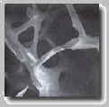 Osteoporotic Tissue Showing Bone Deterioration